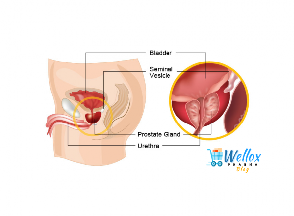 FAQs Related To Prostate Cancer
